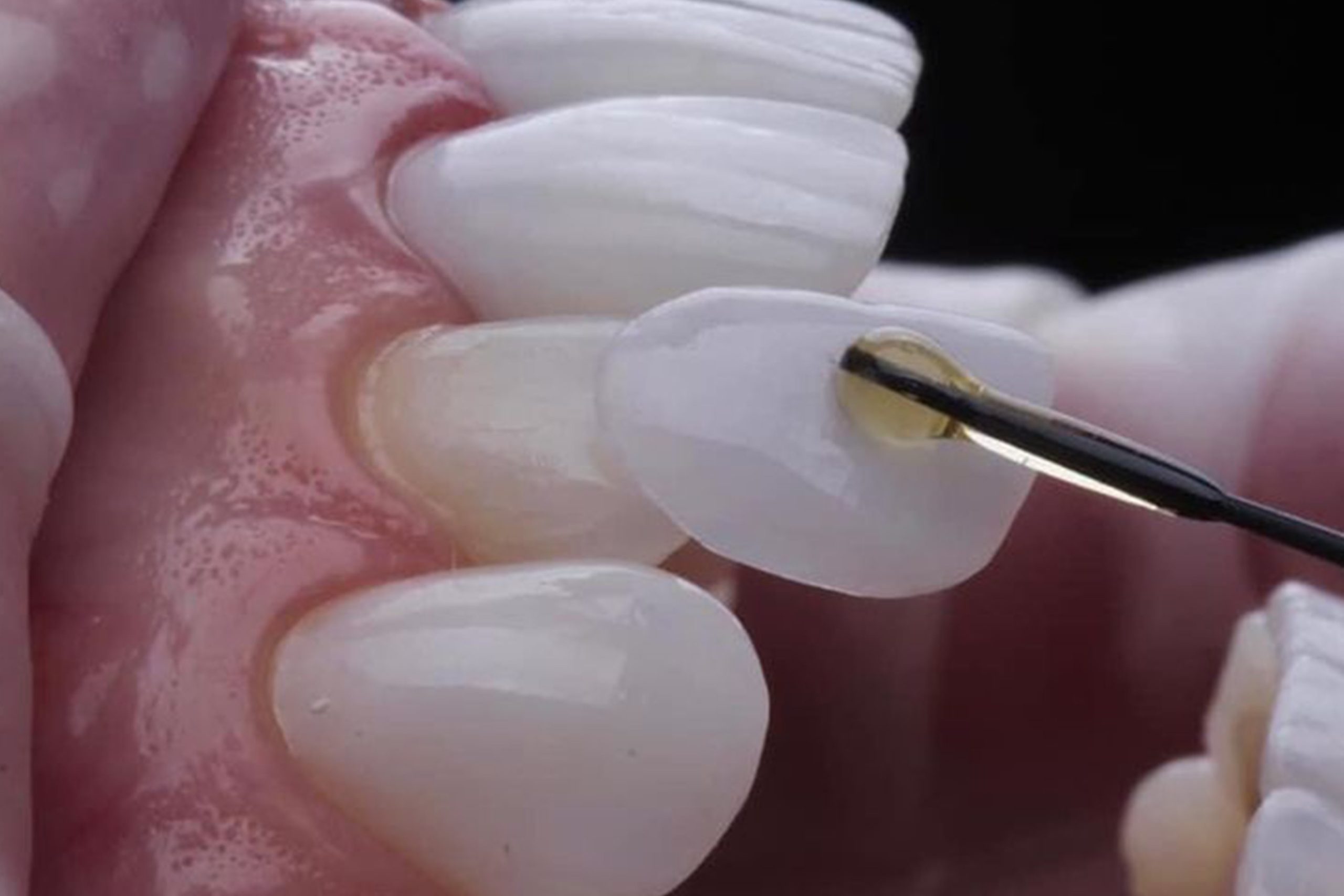 Zirconia veneer/ inlay/ onlay